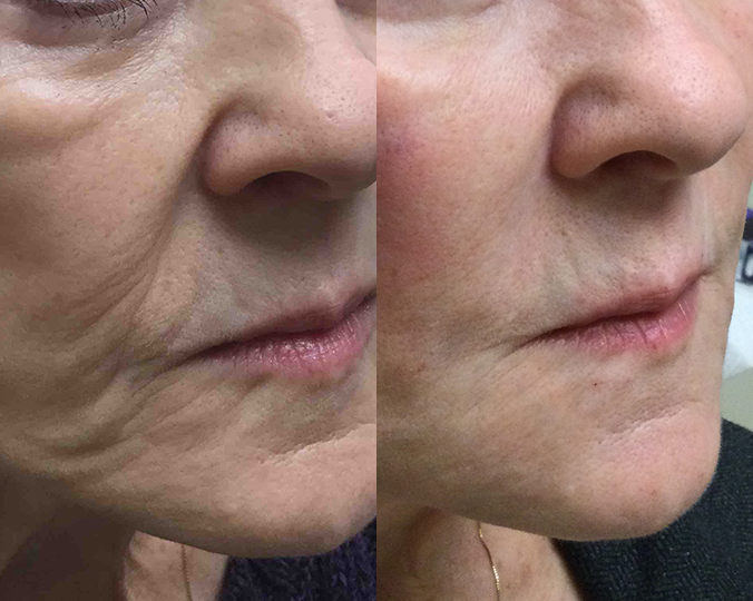 Dermal Filler