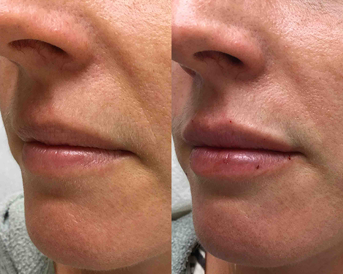 Lip Filler