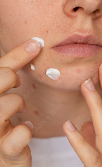 Unrecognizable woman applies makeup, cream serum cure for acne on face. Close-up acne on woman's face with rash skin ,scar and spot that allergic to cosmetics. Problem skincare and health concept