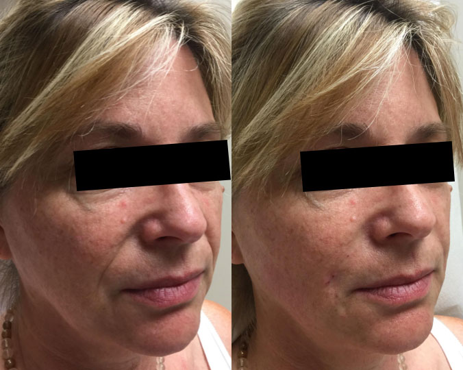 Dermal Filler