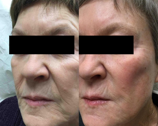 full face HA filler treatment