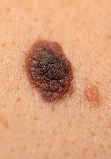 Dangerous nevus on skin - melanoma