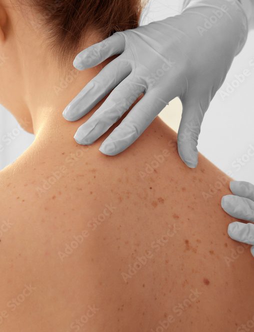 Dermatologist examining patient in clinic, closeup