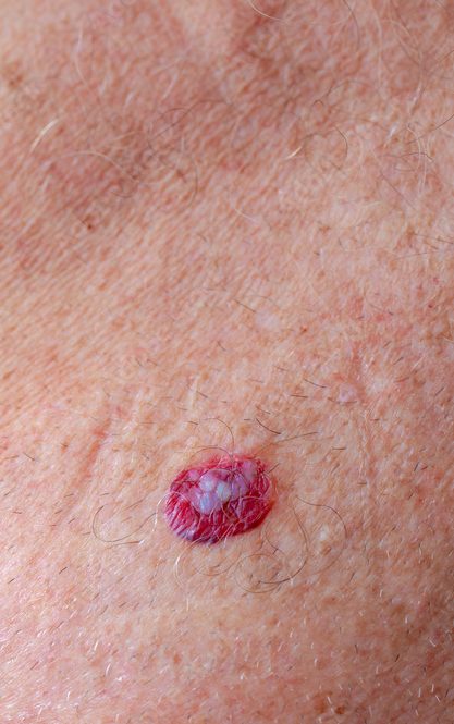 Health care concept, Close up a european senior man with red spot on the right chest, Basal-cell carcinoma (BCC) also known as basal-cell cancer is the most common type of skin cancer.