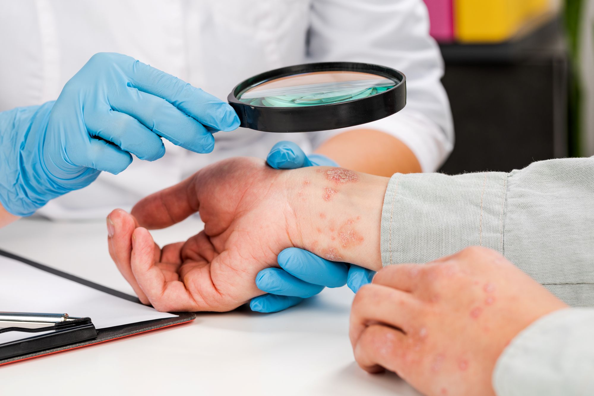 eczema examination