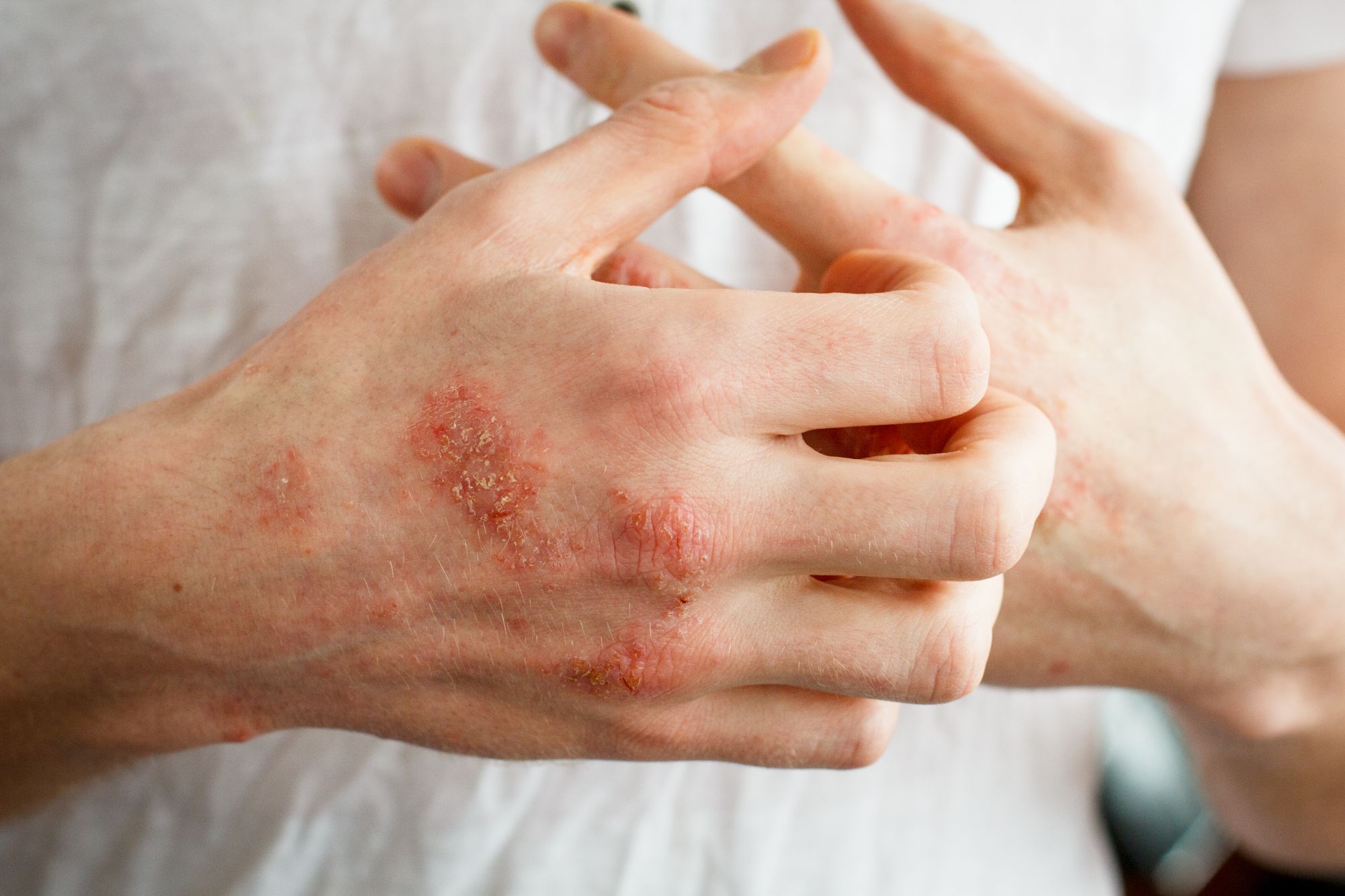 eczema itching