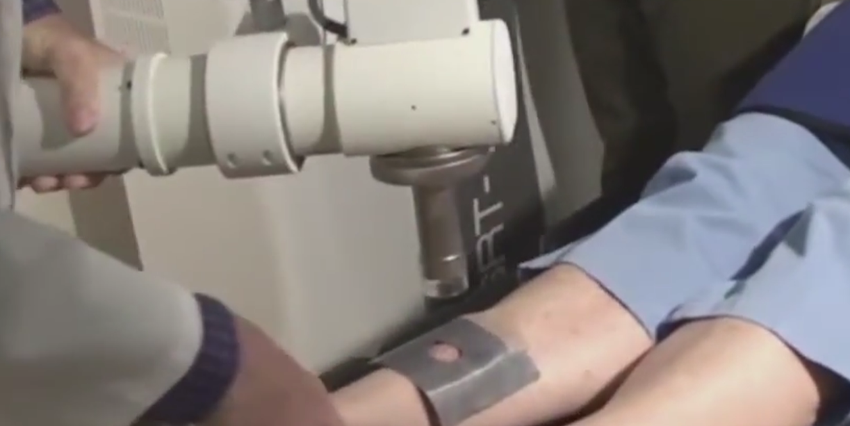 SRT procedure