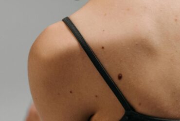 What to Do Right After a Skin Cancer Biopsy: First 48 Hours