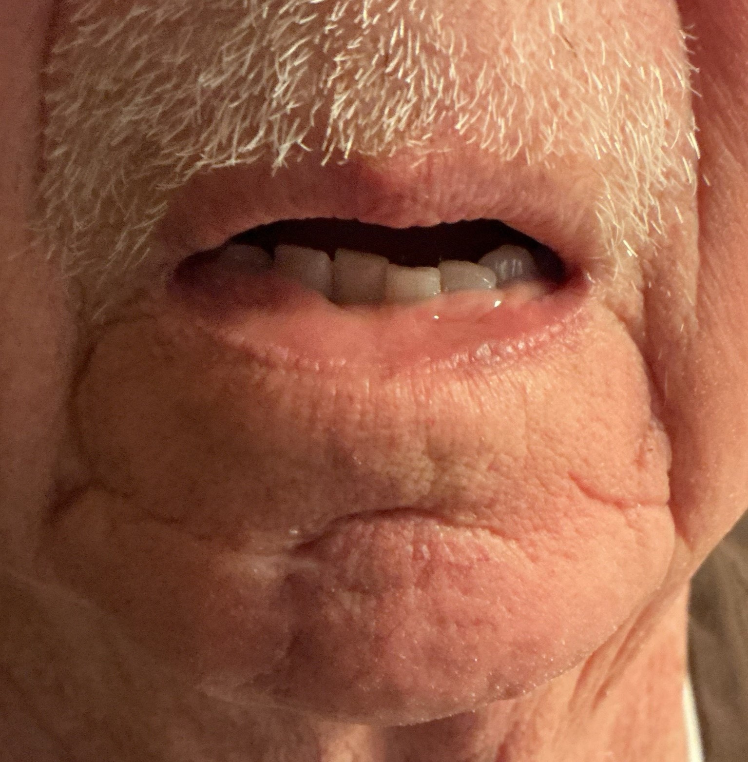 After Nd:YAG laser treatment