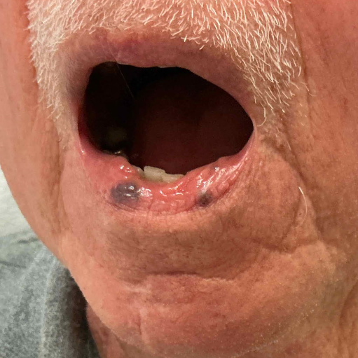 Before Nd:YAG laser treatment