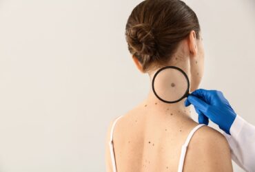 Punch Biopsy vs Shave Biopsy: Healing Stages, Scarring, and What to Expect from Each
