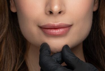 Dermal Fillers: Answering the Questions Our Patients Ask Most